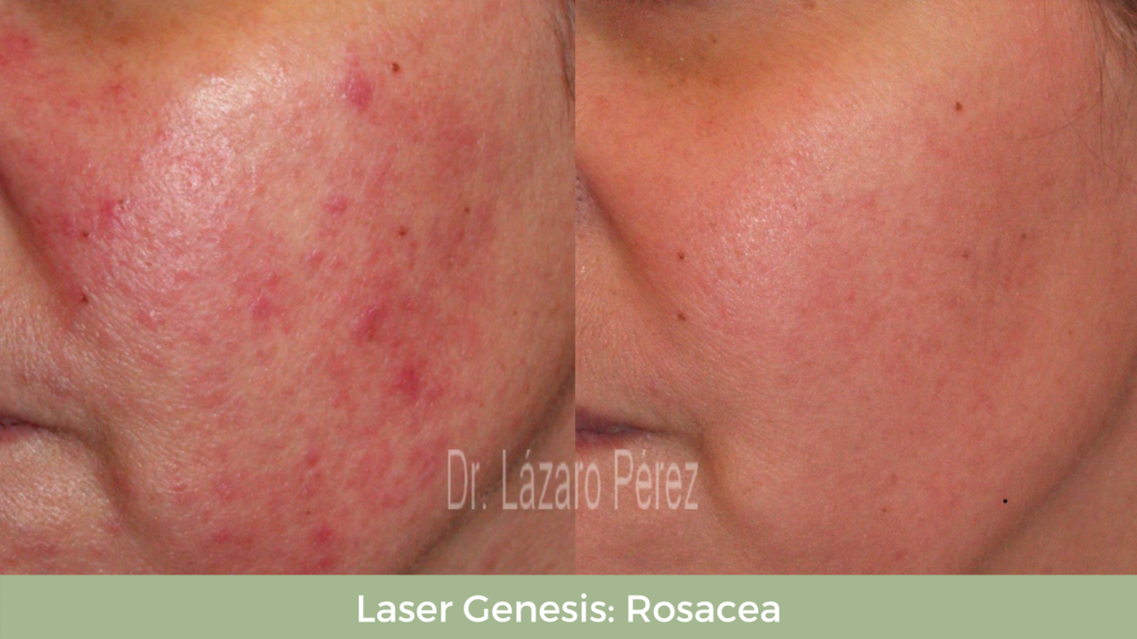 Acne Treatments - Laser Genesis