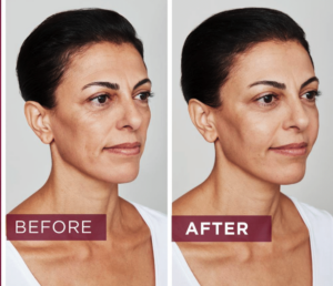 Sculptra Treatment in Sandton - Lasersense